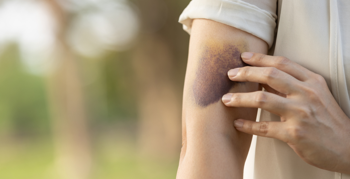 1200 مغربي مصاب بـ"الهيموفيليا" قيد العلاج