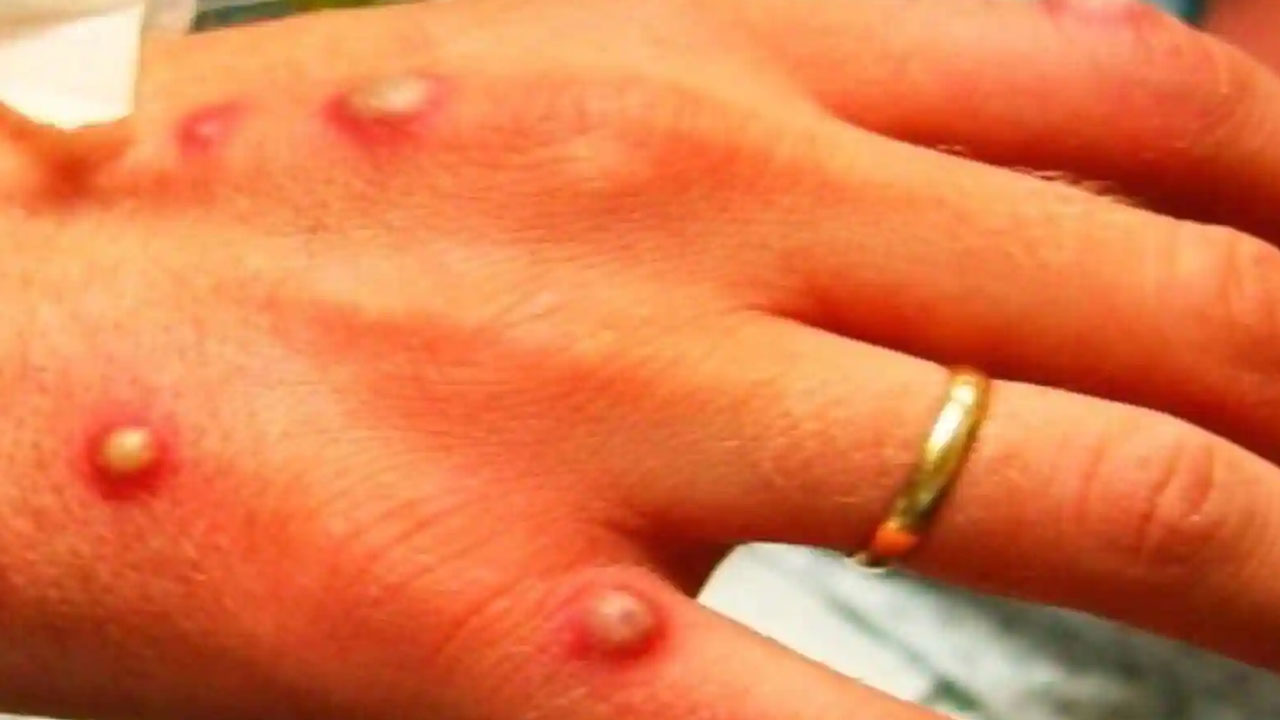 وزارة الصحة: النتائج المخبرية للحالات الثلاث المشتبه في إصابتها بجدري القردة سلبية